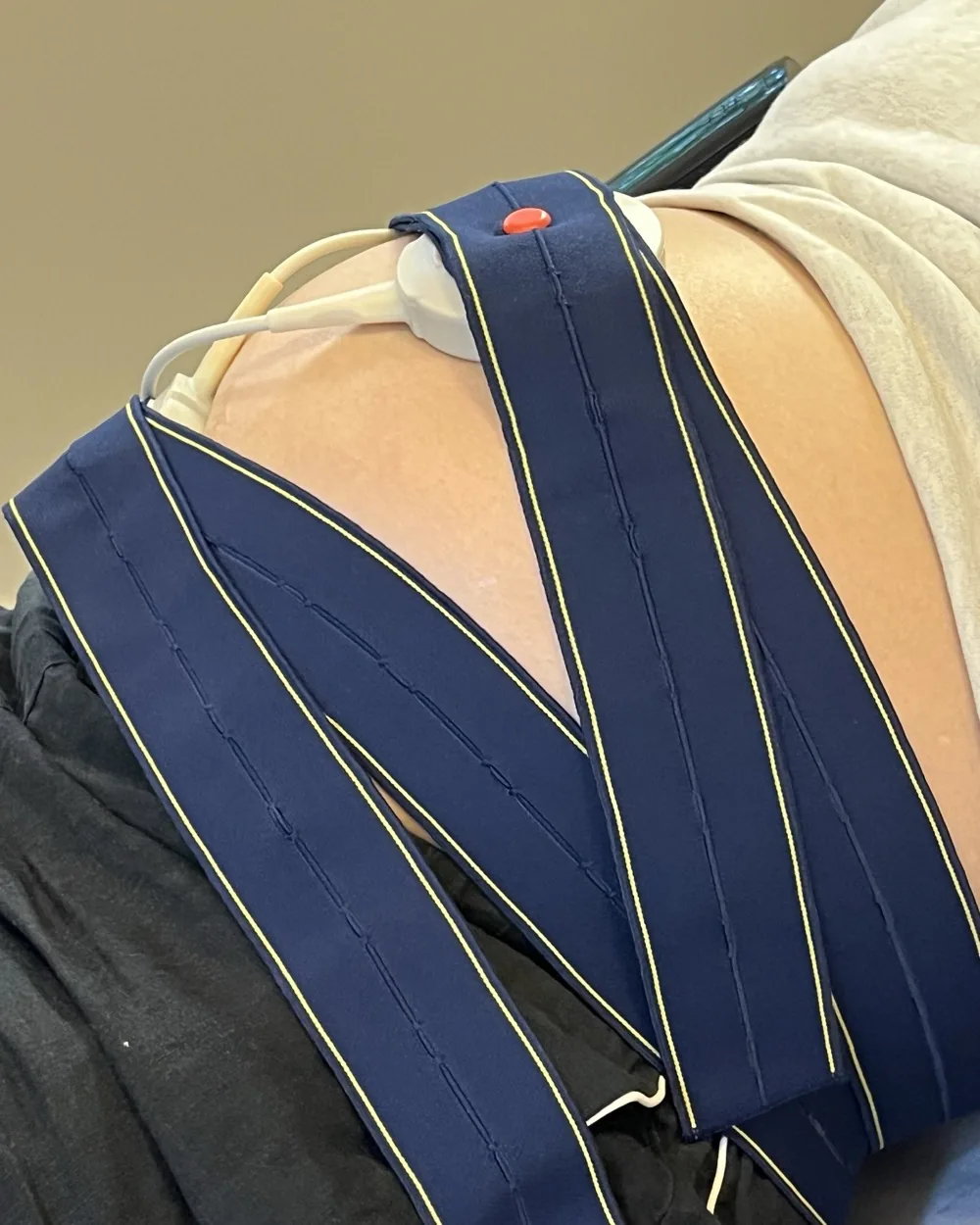Close view of CTG monitoring belts and the fetal heart rate transducer positioned on a pregnant patient's abdomen